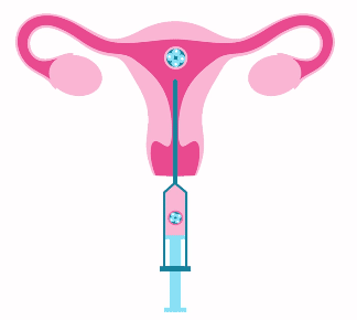 IVF embryo transfer