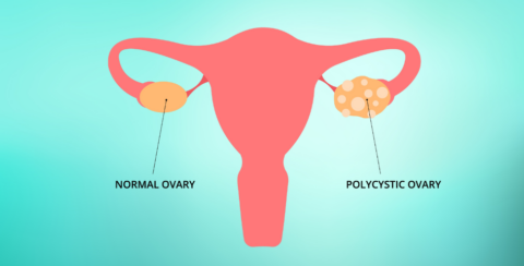 Illustration shows the difference between a normal ovary and a polycystic ovary.