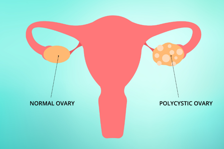 Illustration shows the difference between a normal ovary and a polycystic ovary.