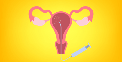 During an IUI sperm is placed closer to the fallopian tubes around the time of ovulation.