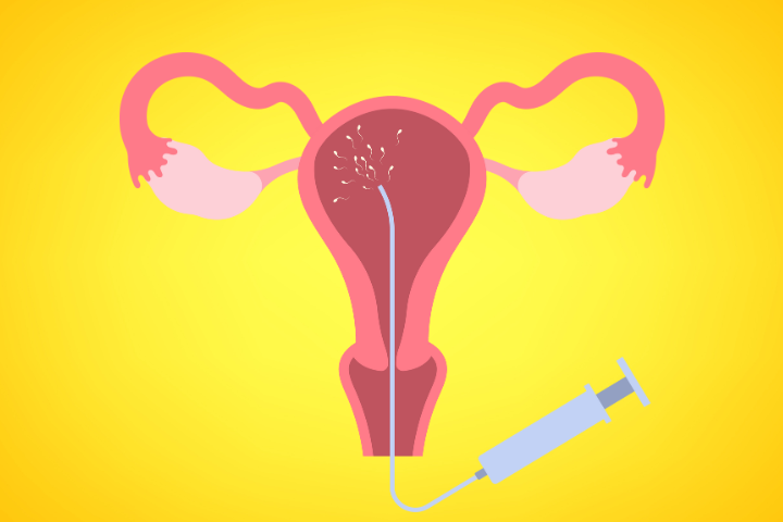 During an IUI sperm is placed closer to the fallopian tubes around the time of ovulation.